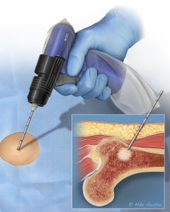Illustration of a femoral bone lesion biopsy.