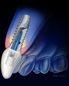 This illustration of a dental implant was created for product marketing.
