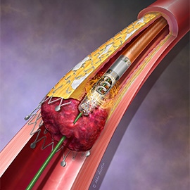 A device that depicts the removal of instent restenosis and thrombus.