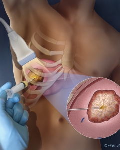 Cover illustration depicting a substance that's injected into a liver tumor for tumor ablation