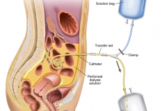 Peritoneal Dialysis Cycle
