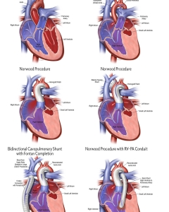 Hypoplastic left heart syndrome (HLHS) is a rare, life-threatening congenital heart defect where the left side of the heart is critically underdeveloped, preventing it from pumping blood effectively. It requires specialized, staged surgeries—Norwood, Glenn, and Fontan—or a heart transplant to survive. Hypoplastic left heart syndrome (HLHS) is a rare, life-threatening congenital heart defect where the left side of the heart is critically underdeveloped, preventing it from pumping blood effectively. It requires specialized, staged surgeries—Norwood, Glenn, and Fontan—or a heart transplant to survive.