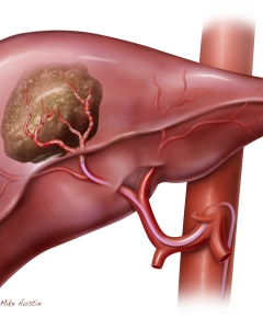 Radioembolization