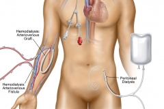 Dialysis Types
