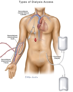 Dialysis treats kidney failure by removing waste, toxins, and excess fluids from the blood. The two primary types are hemodialysis, which uses a machine and artificial filter (dialyzer) to clean blood, and peritoneal dialysis, which uses the abdominal lining (peritoneal membrane) to filter blood inside the body. Arteriovenous fistula. Dialysis treats kidney failure by removing waste, toxins, and excess fluids from the blood. The two primary types are hemodialysis, which uses a machine and artificial filter (dialyzer) to clean blood, and peritoneal dialysis, which uses the abdominal lining (peritoneal membrane) to filter blood inside the body. Arteriovenous fistula.