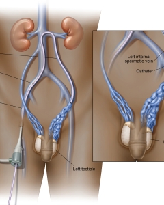 Varicocele embolization is a minimally invasive, non-surgical outpatient procedure that uses catheters and coils/agents to block abnormal veins in the scrotum, treating pain, swelling, and infertility. Varicocele embolization is a minimally invasive, non-surgical outpatient procedure that uses catheters and coils/agents to block abnormal veins in the scrotum, treating pain, swelling, and infertility.
