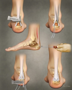 Achilles repair surgery fixes a torn, ruptured, or damaged Achilles tendon using open or minimally invasive (percutaneous) techniques to sew the tendon ends together. Achilles repair surgery fixes a torn, ruptured, or damaged Achilles tendon using open or minimally invasive (percutaneous) techniques to sew the tendon ends together.