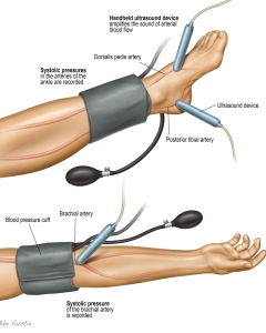 The Ankle-Brachial Index (ABI) is a quick, non-invasive, and painless test that compares systolic blood pressure in the ankle with that in the arm to detect peripheral artery disease (PAD). The Ankle-Brachial Index (ABI) is a quick, non-invasive, and painless test that compares systolic blood pressure in the ankle with that in the arm to detect peripheral artery disease (PAD).