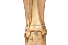 Ankle Syndesmosis