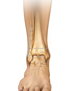 Ankle Syndesmosis