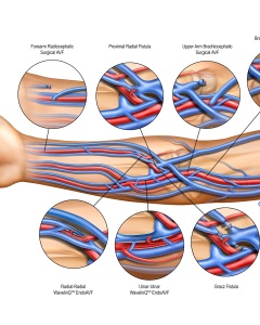 Arteriovenous Fistulas