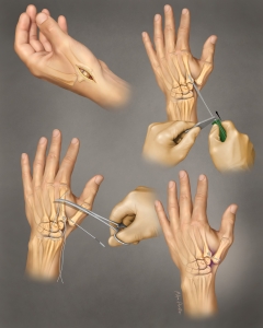 Thumb carpal-metacarpal arthritis repair using the ATLAS device after removal of the trapizium bone.