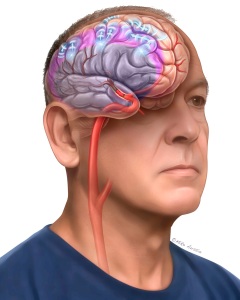 "Brain tsunami" is the colloquial medical term for spreading depolarization (SD). It refers to a massive, destructive wave of electrochemical failure and neuronal activation that ripples outward across the surface of the brain, causing brain cells to short-circuit and potentially die off if energy supplies are critically low "Brain tsunami" is the colloquial medical term for spreading depolarization (SD). It refers to a massive, destructive wave of electrochemical failure and neuronal activation that ripples outward across the surface of the brain, causing brain cells to short-circuit and potentially die off if energy supplies are critically low
