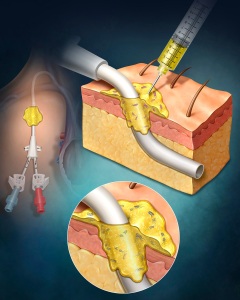 This illustration highlights a catheter insertion site in the chest, emphasizing both anatomical accuracy and infection prevention strategy. The catheter is shown entering the skin and advancing into the underlying vasculature, with careful attention to surrounding tissue layers and placement. At the point of entry, a specialized antimicrobial gel is applied over the skin surface, clearly demonstrating its role as a protective barrier against bacterial contamination.