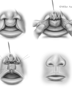 Cleft lip repair is a surgical procedure, typically performed around 3 to 6 months of age, that corrects a separation in the upper lip by reallocating tissue and repairing muscle to improve function and appearance. Cleft lip repair is a surgical procedure, typically performed around 3 to 6 months of age, that corrects a separation in the upper lip by reallocating tissue and repairing muscle to improve function and appearance.