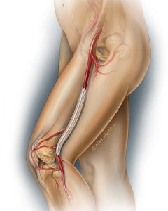 Drug eluting balloon in a peripheral artery in the thigh to treat peripheral artery disease. Drug eluting balloon in a peripheral artery in the thigh to treat peripheral artery disease.