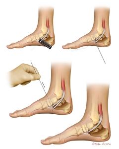 Flexor digitorum longus tendon transfer in the foot.
