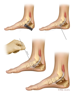 A Flexor Digitorum Longus (FDL) tendon transfer is a foot surgery that reroutes the FDL tendon, typically to support a weakened posterior tibial tendon, correct a fallen arch (flatfoot), or augment Achilles function, by attaching it to the navicular bone or other structures for improved arch support and pain relief. A Flexor Digitorum Longus (FDL) tendon transfer is a foot surgery that reroutes the FDL tendon, typically to support a weakened posterior tibial tendon, correct a fallen arch (flatfoot), or augment Achilles function, by attaching it to the navicular bone or other structures for improved arch support and pain relief.