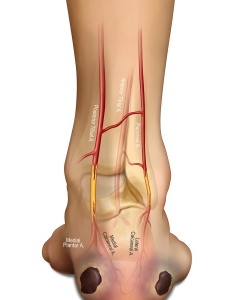 Ischemic foot ulcers are painful, slow-healing wounds caused by severe poor circulation (peripheral artery disease) reducing oxygen to tissue, resulting in cell death. They typically appear as dry, punched-out, deep craters on tips of toes, heels, or between toes, often with black necrotic tissue. Treatment focuses on restoring blood flow (revascularization), wound care, and infection prevention. Ischemic foot ulcers are painful, slow-healing wounds caused by severe poor circulation (peripheral artery disease) reducing oxygen to tissue, resulting in cell death. They typically appear as dry, punched-out, deep craters on tips of toes, heels, or between toes, often with black necrotic tissue. Treatment focuses on restoring blood flow (revascularization), wound care, and infection prevention.