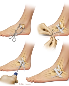 The Broström procedure is a common outpatient, minimally invasive ankle surgery used to repair the lateral ankle ligaments (specifically the ATFL) for chronic instability, boasting a 90-95% success rate and return to sport within 6 months. It involves tightening the torn ligaments and, in the Brostrom-Gould modification, reinforcing them with surrounding tissue. The Broström procedure is a common outpatient, minimally invasive ankle surgery used to repair the lateral ankle ligaments (specifically the ATFL) for chronic instability, boasting a 90-95% success rate and return to sport within 6 months. It involves tightening the torn ligaments and, in the Brostrom-Gould modification, reinforcing them with surrounding tissue.