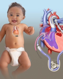 These medical illustrations were created in collaboration with a pediatric surgeon to support journal articles focused on the surgical treatment of hypoplastic left heart syndrome (HLHS). The illustrations depict ventricular assist devices (VADs) placed following the Norwood procedure. These medical illustrations were created in collaboration with a pediatric surgeon to support journal articles focused on the surgical treatment of hypoplastic left heart syndrome (HLHS). The illustrations depict ventricular assist devices (VADs) placed following the Norwood procedure.
