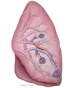 A pulmonary arteriovenous malformation (PAVM) is a rare vascular anomaly creating a direct, capillary-free connection between pulmonary arteries and veins, causing a right-to-left shunt. Primarily caused by hereditary hemorrhagic telangiectasia (HHT), these lesions lead to low oxygen levels (hypoxemia), causing shortness of breath, fatigue, cyanosis, and clubbing. Untreated, they risk severe complications like stroke or brain abscess, typically managed with transcatheter embolotherapy. A pulmonary arteriovenous malformation (PAVM) is a rare vascular anomaly creating a direct, capillary-free connection between pulmonary arteries and veins, causing a right-to-left shunt. Primarily caused by hereditary hemorrhagic telangiectasia (HHT), these lesions lead to low oxygen levels (hypoxemia), causing shortness of breath, fatigue, cyanosis, and clubbing. Untreated, they risk severe complications like stroke or brain abscess, typically managed with transcatheter embolotherapy.