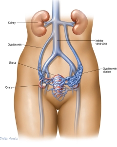 Pelvic Congestion Syndrome (PCS), or pelvic venous disorder, is a chronic pain condition caused by dysfunctional valves in pelvic veins, causing blood to pool (varicose veins) and engorge around the ovaries and uterus. Pelvic Congestion Syndrome (PCS), or pelvic venous disorder, is a chronic pain condition caused by dysfunctional valves in pelvic veins, causing blood to pool (varicose veins) and engorge around the ovaries and uterus.