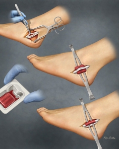 Peroneal tendon repair is a surgical procedure, typically involving an open incision on the outside of the ankle, to repair tears or stabilize subluxing (dislocating) tendons that cause chronic lateral ankle pain. The procedure involves debriding degenerated tissue, suturing tendon tears, and often deepening the bony groove or reconstructing the retinaculum to hold tendons in place Peroneal tendon repair is a surgical procedure, typically involving an open incision on the outside of the ankle, to repair tears or stabilize subluxing (dislocating) tendons that cause chronic lateral ankle pain. The procedure involves debriding degenerated tissue, suturing tendon tears, and often deepening the bony groove or reconstructing the retinaculum to hold tendons in place