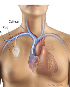 Subclavian port placement involves surgically implanting a small device under the skin, usually just below the collarbone (clavicle), to provide long-term venous access for medication, chemo, or blood draws. Subclavian port placement involves surgically implanting a small device under the skin, usually just below the collarbone (clavicle), to provide long-term venous access for medication, chemo, or blood draws.
