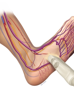 An arteriovenous (AV) fistula in the lower leg can be surgically created to revascularize ischemic feet or toes by directly connecting an artery to a nearby vein, often using the reversed great saphenous vein, to increase peripheral blood flow. An arteriovenous (AV) fistula in the lower leg can be surgically created to revascularize ischemic feet or toes by directly connecting an artery to a nearby vein, often using the reversed great saphenous vein, to increase peripheral blood flow.