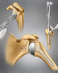 Part of a large series of steps to depict total shoulder replacement.
