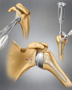 Total shoulder replacement (arthroplasty) removes damaged bone and cartilage, replacing them with a metal ball and a plastic socket to relieve severe, non-responsive arthritis or fracture pain. Total shoulder replacement (arthroplasty) removes damaged bone and cartilage, replacing them with a metal ball and a plastic socket to relieve severe, non-responsive arthritis or fracture pain.