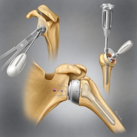 Part of a large series of steps to depict total shoulder replacement.
