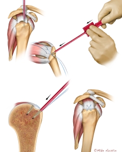 Rotator cuff repair is a surgical procedure, often performed arthroscopically, to reattach torn shoulder tendons to the humerus bone using anchors and sutures, relieving pain and restoring function. Rotator cuff repair is a surgical procedure, often performed arthroscopically, to reattach torn shoulder tendons to the humerus bone using anchors and sutures, relieving pain and restoring function.
