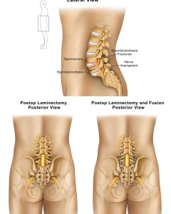Spondylosis is a common, age-related degenerative condition caused by the wear and tear of spinal vertebrae, discs, and joints, often referred to as osteoarthritis of the spine. A laminectomy is a surgical decompression procedure that removes part of the vertebral bone (the lamina) to relieve spinal nerve pressure caused by stenosis, herniated discs, or tumors. Spondylosis is a common, age-related degenerative condition caused by the wear and tear of spinal vertebrae, discs, and joints, often referred to as osteoarthritis of the spine. A laminectomy is a surgical decompression procedure that removes part of the vertebral bone (the lamina) to relieve spinal nerve pressure caused by stenosis, herniated discs, or tumors.