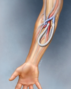 An AV (arteriovenous) loop graft in the arm is a synthetic tube, often PTFE, surgically placed to connect an artery and vein for hemodialysis access when suitable veins for a native fistula are unavailable. An AV (arteriovenous) loop graft in the arm is a synthetic tube, often PTFE, surgically placed to connect an artery and vein for hemodialysis access when suitable veins for a native fistula are unavailable.
