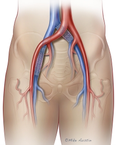 Venous Stent