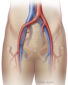 Vein stents placed in the iliac and femoral veins with pelvic anatomy in the background. Vein stents placed in the iliac and femoral veins with pelvic anatomy in the background.
