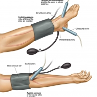 The Ankle-Brachial Index (ABI) is a quick, non-invasive, and painless test that compares systolic blood pressure in the ankle with that in the arm to detect peripheral artery disease (PAD).