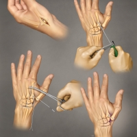 Thumb carpal-metacarpal arthritis repair using the ATLAS device after removal of the trapizium bone.
