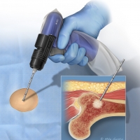 The TREK bone marrow biopsy system is intended for bone marrow aspiration and biopsy.