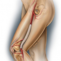 Drug eluting balloon in a peripheral artery
