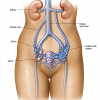 Pelvic Congestion Syndrome (PCS), or pelvic venous disorder, is a chronic pain condition caused by dysfunctional valves in pelvic veins, causing blood to pool (varicose veins) and engorge around the ovaries and uterus.
