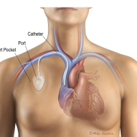 Subclavian port placement involves surgically implanting a small device under the skin, usually just below the collarbone (clavicle), to provide long-term venous access for medication, chemo, or blood draws.