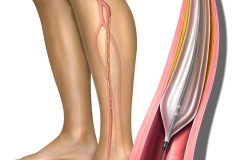 Peripheral Artery Disease