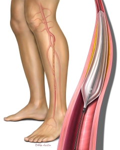 Peripheral Artery Disease (PAD) angioplasty is a minimally invasive, catheter-based procedure designed to open narrowed or blocked arteries, usually in the legs, to restore blood flow.