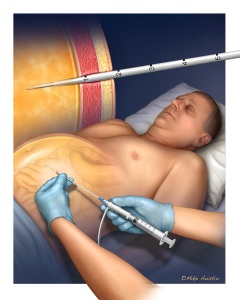 Paracentesis procedure to remove ascites from the peritoneal cavity in the abdomen.