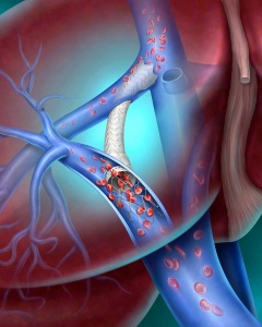 TIPS Procedure TIPS Procedure