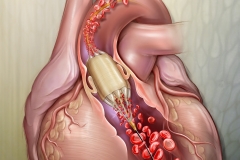 Valvuloplasty perfusion catheter that allows blood flow while the balloon is inflated.