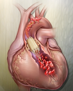 The True™ Flow Valvuloplasty Perfusion Catheter (BD) is a specialized balloon catheter used to treat stenotic (narrowed) heart valves by allowing continuous blood flow during inflation, reducing the need for rapid pacing.